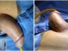 Penile Prosthesis Implant Infrapubic Approach